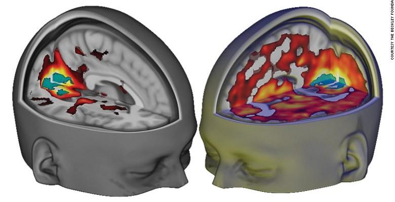 Why Psychedelic-Assisted Psychotherapy Works